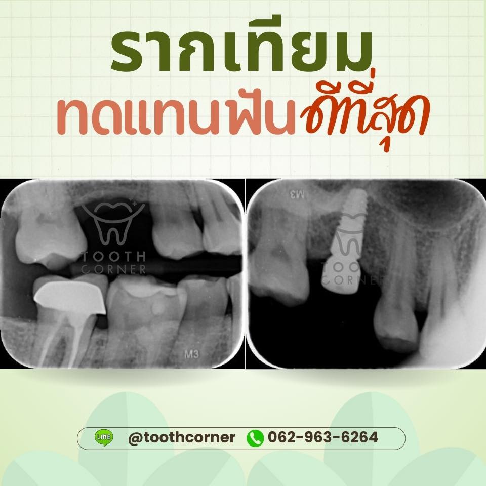 🦄🦋🌷ฟันที่ถอนไป... - Tooth Corner Clinic - ทูธคอร์เนอะ สหคลินิก | Facebook