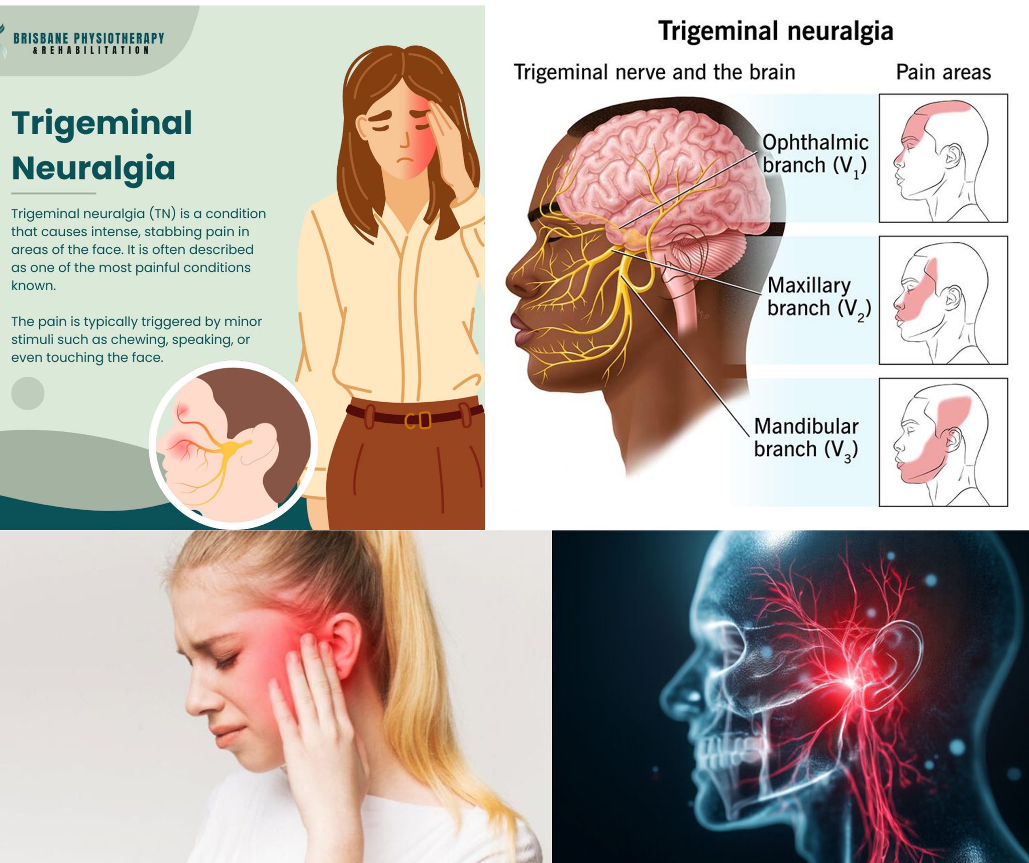acupoint injections of vitamin b12 for trigeminal neuralgia ⚡ Neuropathy: Facial Nerve Damage That Changes Sensation & Pain 🤯 Interesting Fact The Trigeminal nerve is responsible most facial sensation—so when it's affected, even simple things like brushing teeth tighten skin 💉 Vitamin B12 💉 Net Weight:50mg