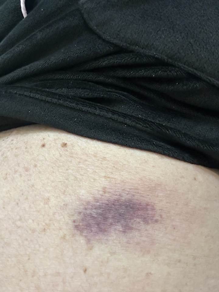 bruise after b12 injection Common Mistakes in Injections to Avoid b12 injection bruising site Heavy
