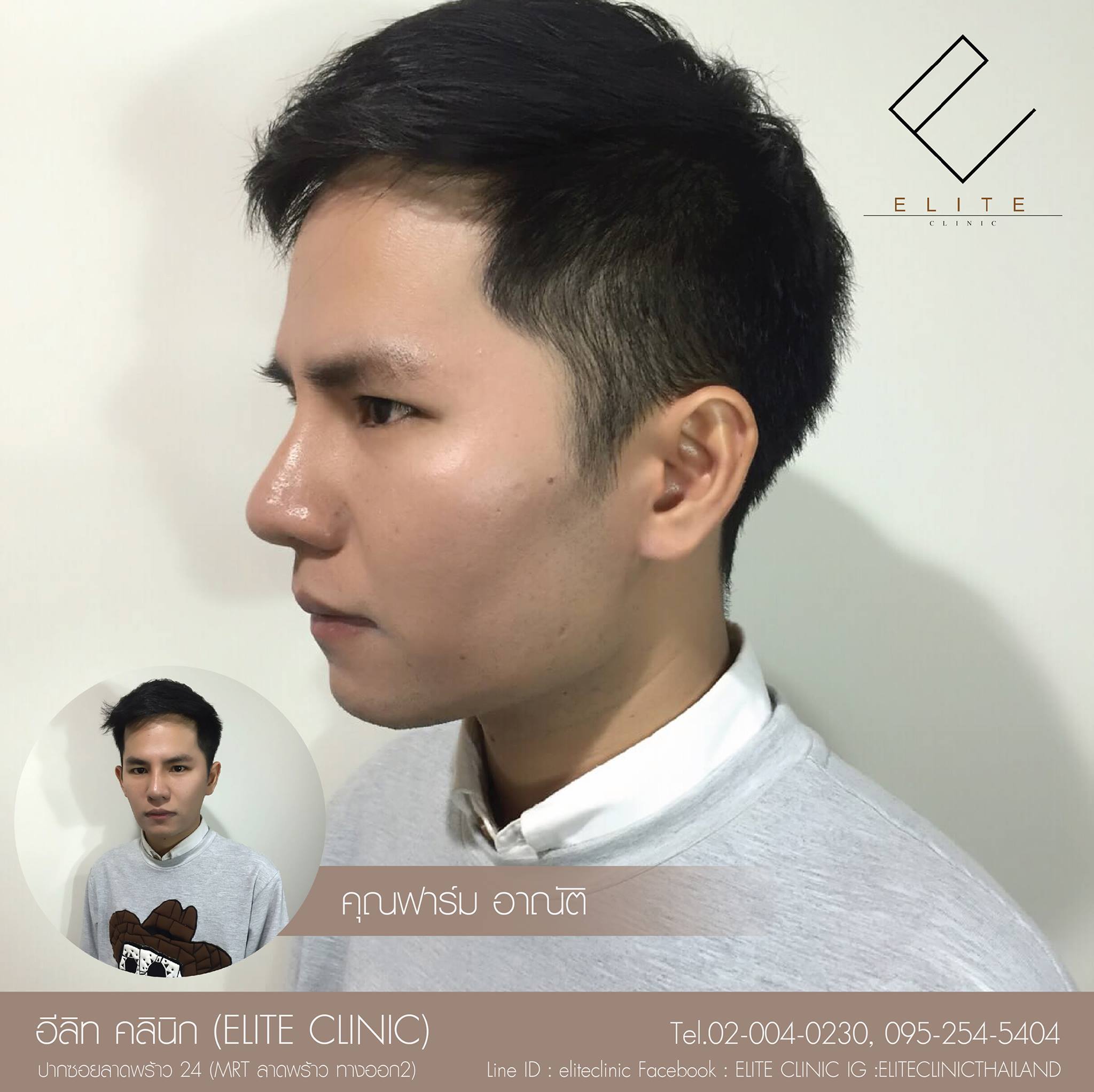 ELITE CLINIC เสริมจมูก ตาสองชั้น เสริมคาง ศัลยกรรมความงาม ปรับรูปหน้า ...