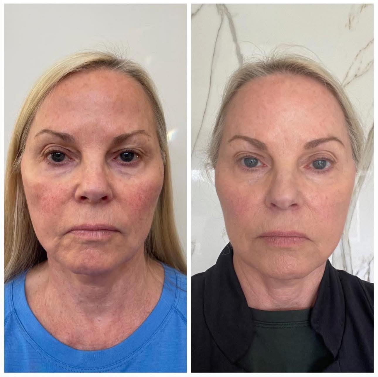 glutathione thedermreview Introducing high-tech, natural skincare to unlock superhuman skin. 🌞 Proprietary ingredients including Neossance™ Vegan Shark Squalane 🏄 For athletes by athletes, for the first time 🏆 Developed by 11x World Champion Surfer Program:8 Week Skin and Tissue Optimization Glutathione Drip Nature Glow Glutathione Collagen