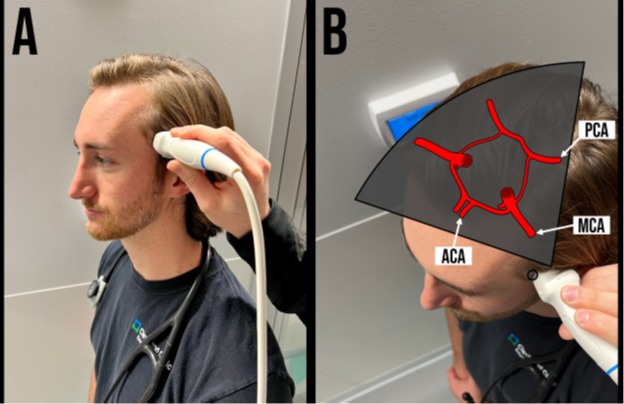 Caduceus EM & Critical Care FOAM | 🩺Transcranial Doppler in the ...