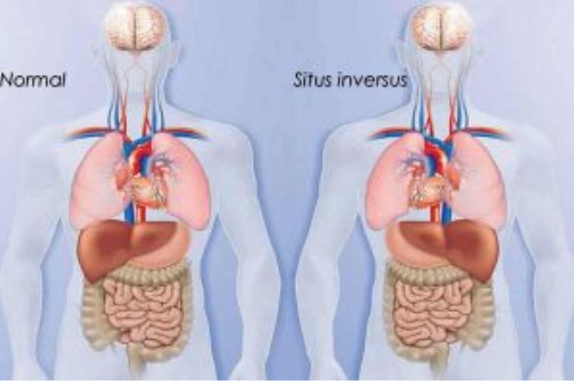 PCD Australia - Situs inversus totalis is a condition... | Facebook