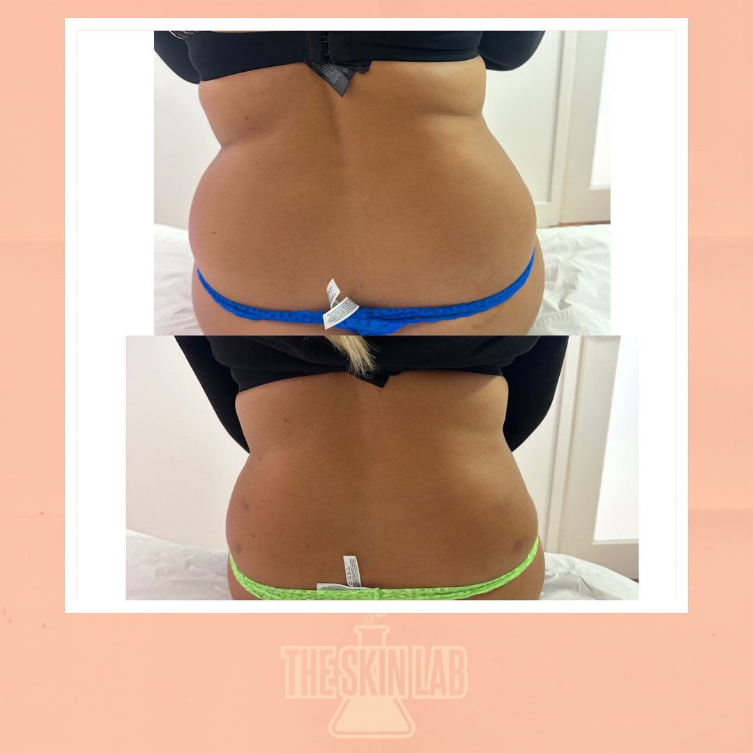 Lemon Bottle Love Handle 🍋 . . These photos are taken less than 24 hours apart! 😮‍💨🤩 . . No downtime… for best results you must drink 3 litres of water a
