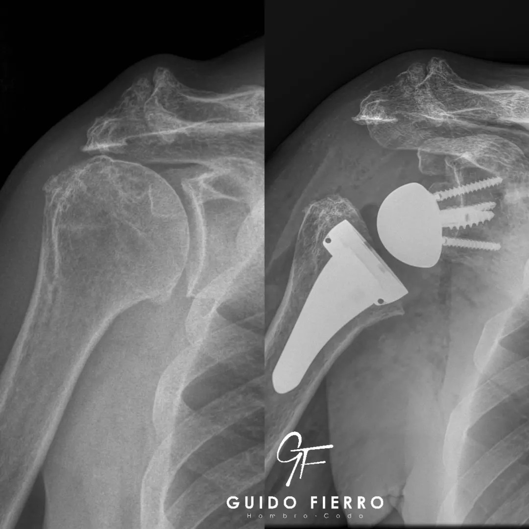 Reverse Shoulder Arthroplasty... - Cirugía de Hombro y Codo | Facebook