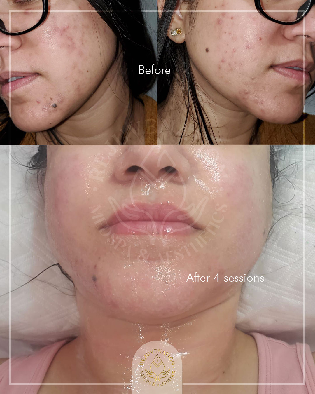 cosderma glutathione whitening cream review Ready for glassskin glow? Try our new ExoExpert Facial Kit a 6 step medi facial with exosomes that deeply hydrate, brighten, and revive your skin 🌟 Powered by exosome-based technology, niacinamide Healthy eyes in a SWISSE Astaxanthin + Gluta Cantidad:9 PIEZAS